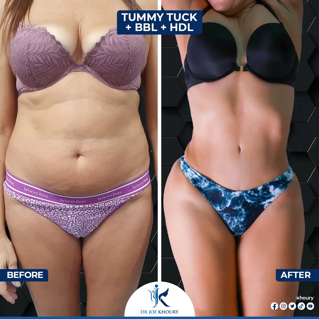 A before-and-after image showcasing the transformative effects of a tummy tuck, breast lift, and implant exchange. The left side displays the pre-surgery appearance, while the right side highlights the enhanced body contours post-procedure.