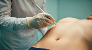 Plastic surgeon drawing liposuction markings on a patient's abdomen during a pre-surgery consultation.