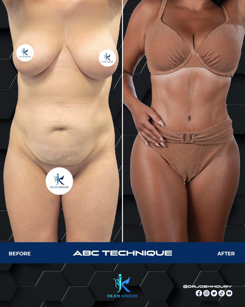 ABC technique performed by Dr Joe Khoury.