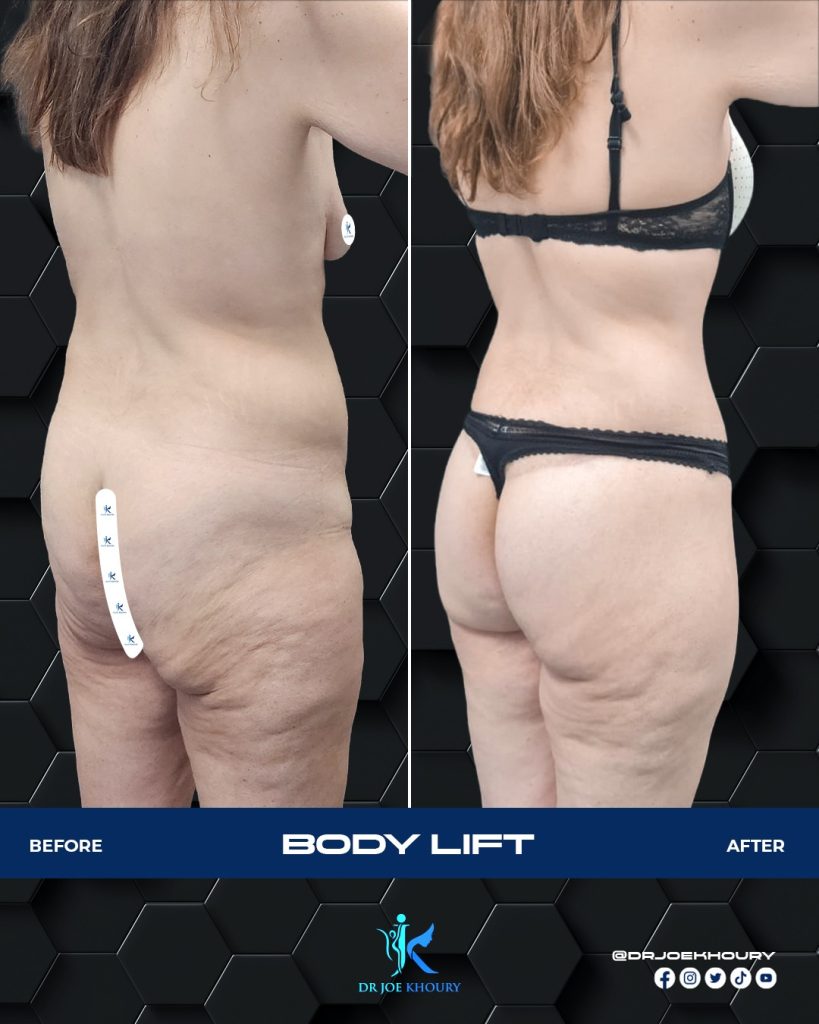 lower body lift before and after.